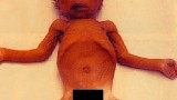 Bayi yang terlampau kering meninggal dunia bayi-dehydaration