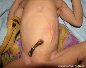 bayi-kulit-kering