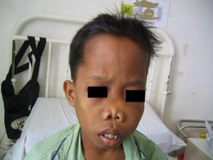 Thalassaemia Clinical Features thalassaemia-clinical-features