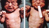 neonatal-tetanus