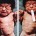 neonatal-tetanus
